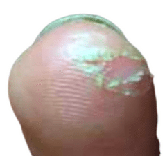 Fingertips Hurt Playing Guitar - Photo of a damaged finger callus.